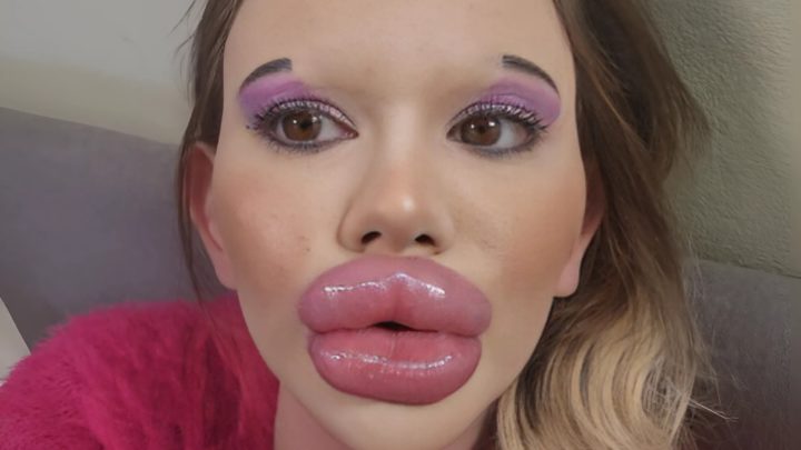 Dieses Mädchen hat wirklich die größten Lippen, aber sie wollte etwas an ihrem Aussehen ändern, also hat sie eine Menge verändert