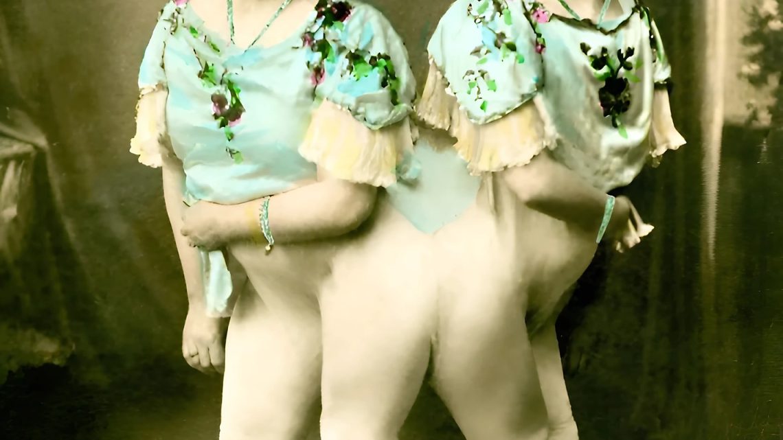Eine Frau mit siamesischen Zwillingen ist Mutter geworden. Wie sieht ihr Baby aus? Eine Frau mit siamesischen Zwillingen ist Mutter geworden. Wie sieht ihr Baby aus?