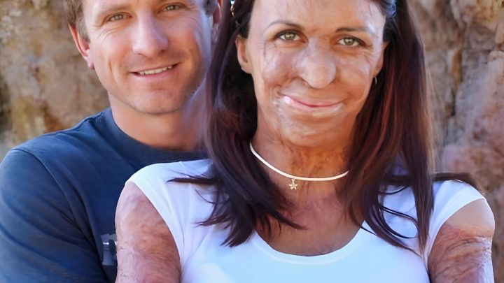 Zweihundert Operationen, die Leben zurückbrachten. Die erstaunliche Geschichte eines australischen Models, das Opfer eines Brandes wurde