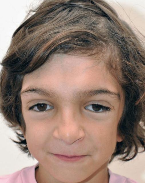 Die Ärzte konnten das Gesicht dieses Jungen wiederherstellen. Sehen Sie nur, wie er heute aussieht.