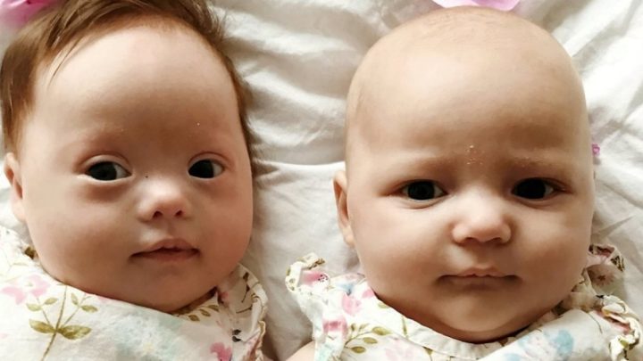 Zwillinge mit einer Chance von eins zu einer Million: Eine hat das Down-Syndrom, die andere nicht!