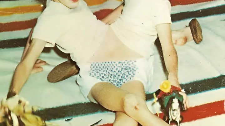 Diese Zwillingsbrüder wurden am Bauch und Becken zusammengewachsen geboren.