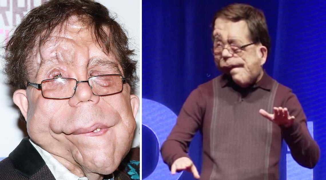 Die unglaubliche Geschichte des Schauspielers Adam Pearson: Er ist eine Inspiration für Millionen von Menschen.