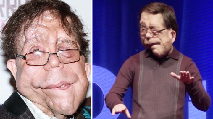 Die unglaubliche Geschichte des Schauspielers Adam Pearson: Er ist eine Inspiration für Millionen von Menschen.