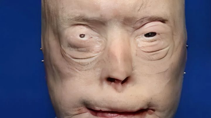 Feuerwehrmann erleidet Verbrennungen dritten Grades – so sieht er 7 Jahre später aus