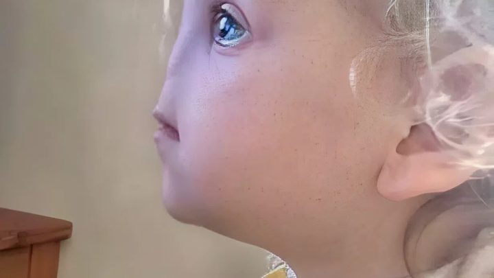 Ohne Nase geboren – so sieht Tessa Evans mit 12 Jahren aus